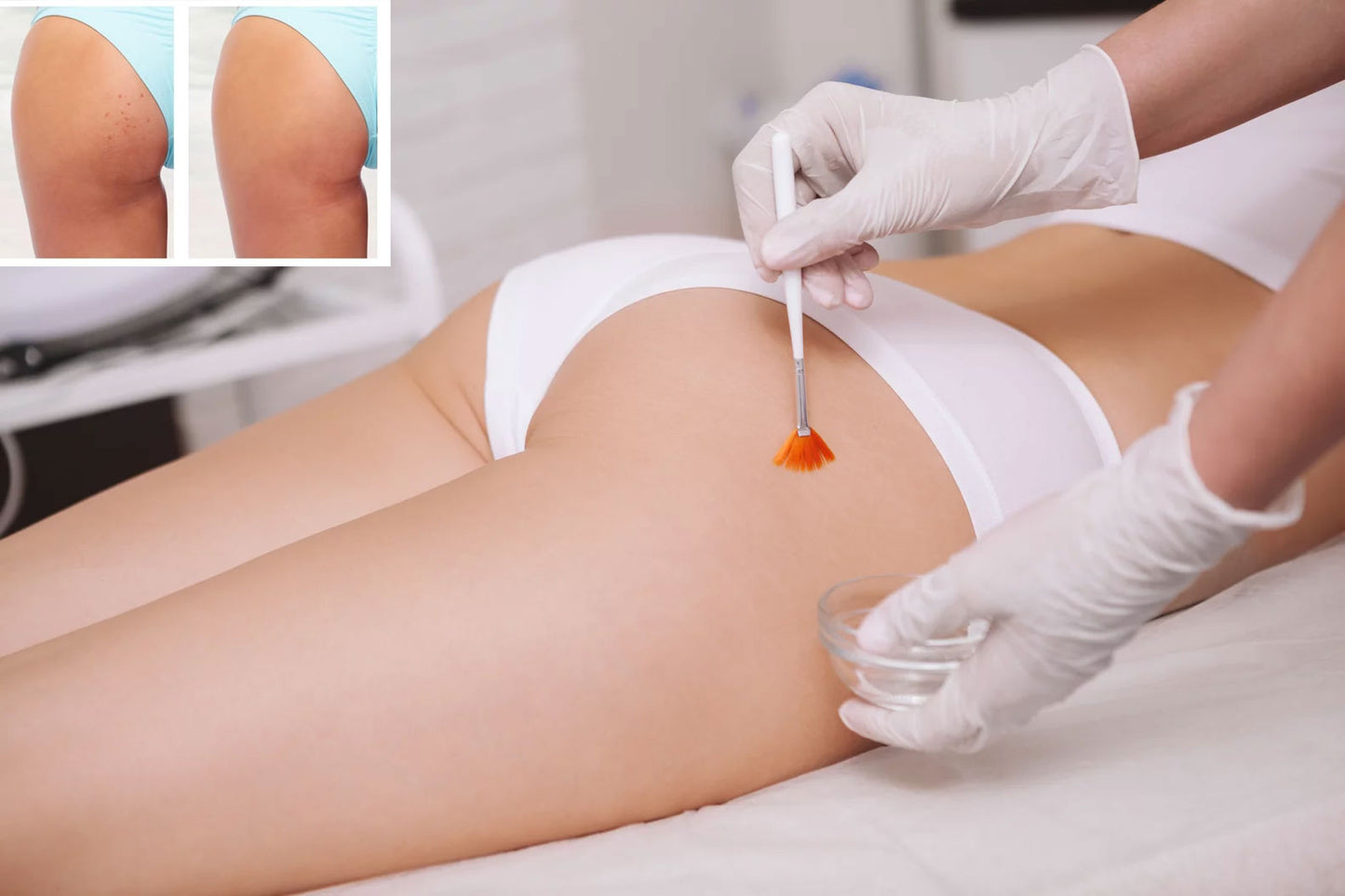 Spezialpflege für den Po: Sanfte Aknebehandlung und Reinigung